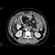 Carcinosis of mesentery: CT - Computed tomography
